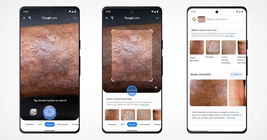 Google Lens-ը սովորել է ճանաչել մաշկային հիվանդությունները
